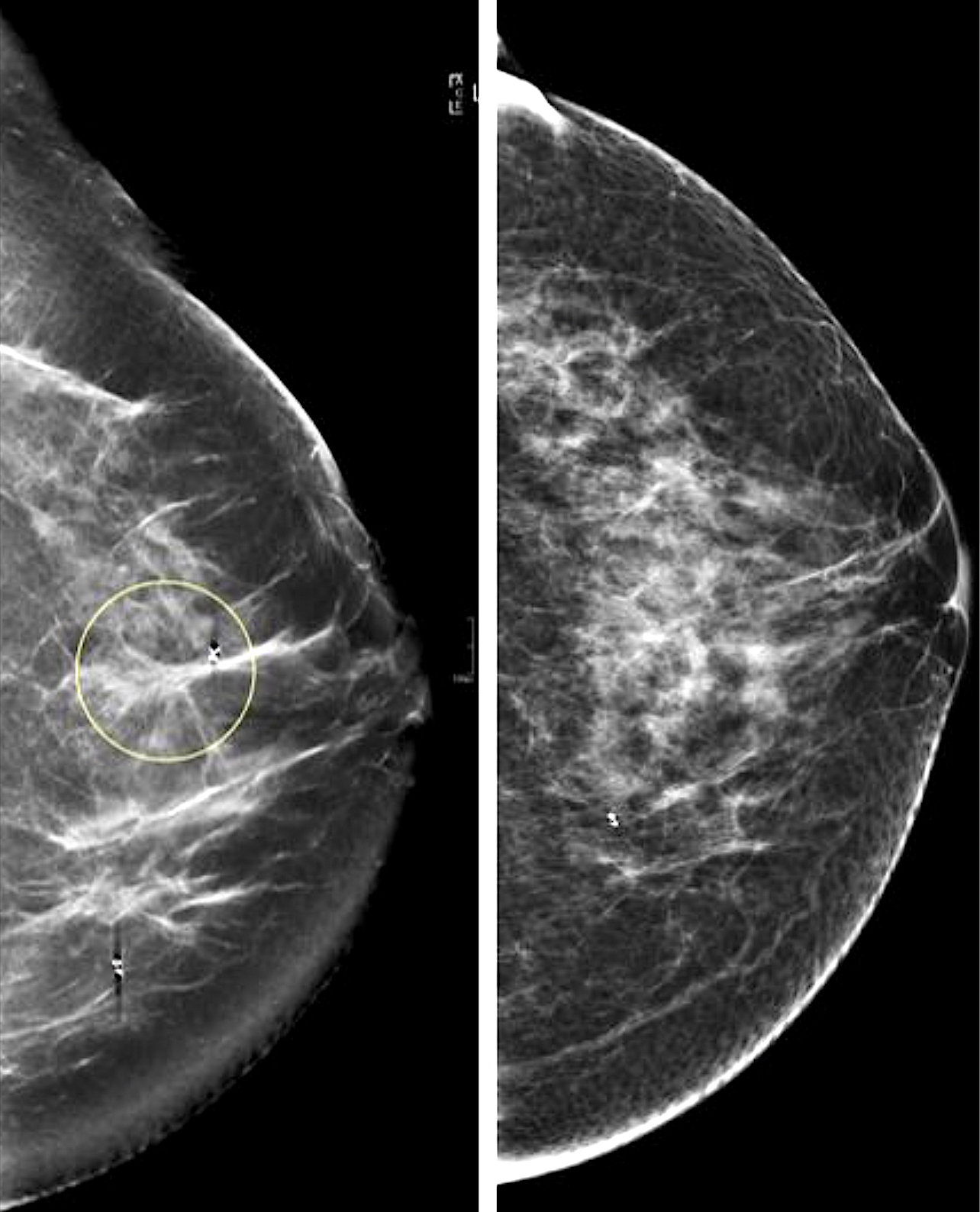 Diagnostic Breast Imaging 第2版 Diagnostic Imaging: Breast: 9780323548120: Medicine & Health