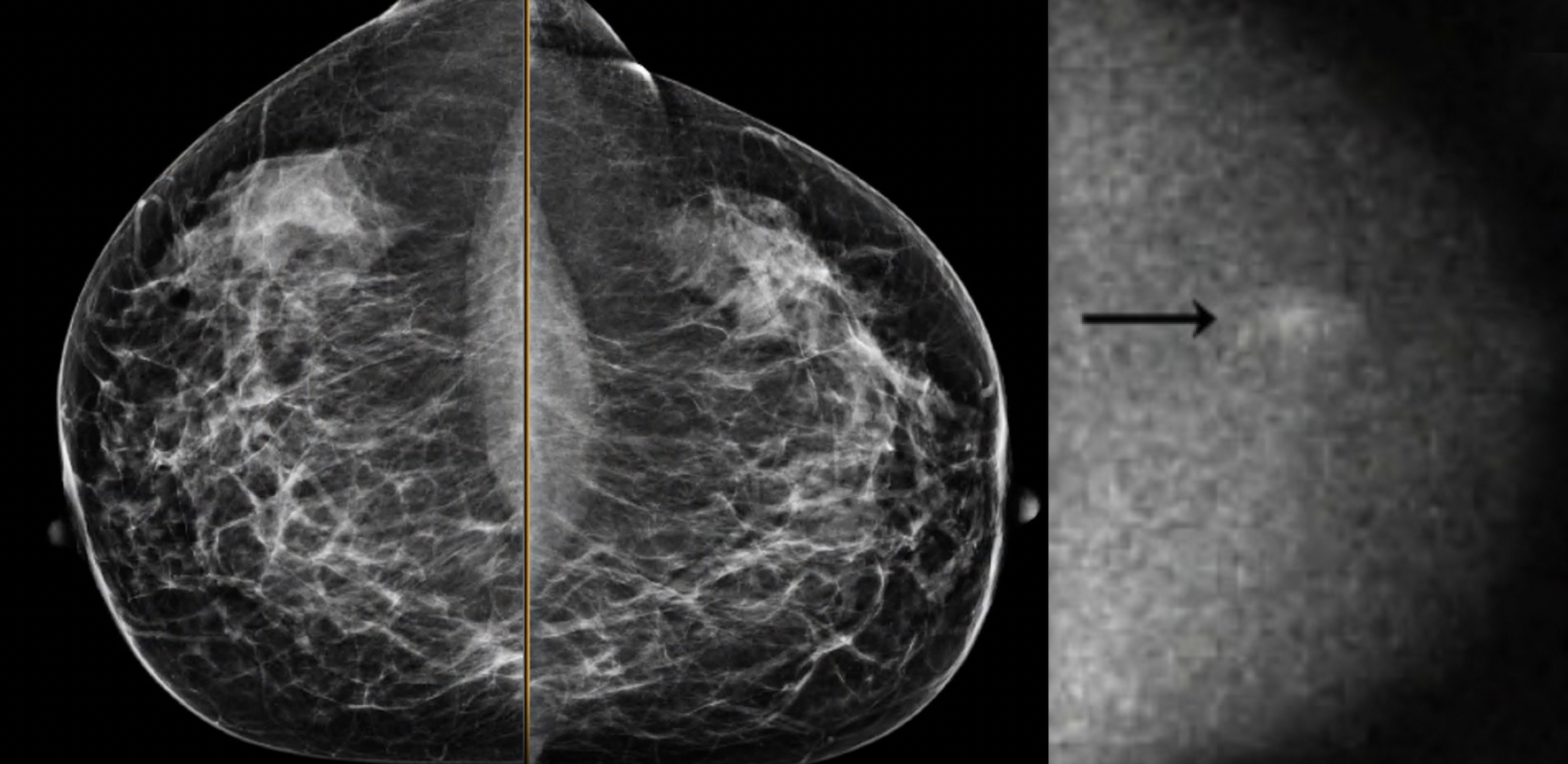 健康・医学 Breast Cancer T-DM1/Brain SRS May Increase Risk of Radionecrosis in Breast