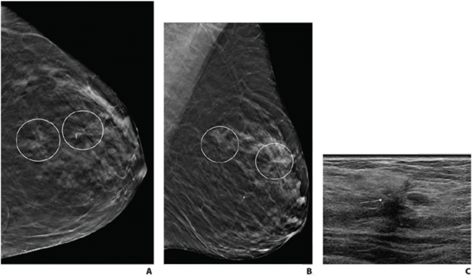 PHOTO GALLERY: What does breast cancer look like on mammography