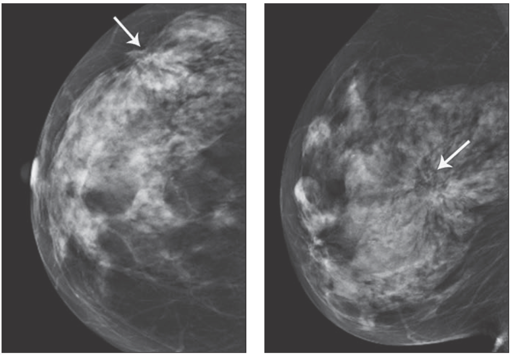 PHOTO GALLERY: What does breast cancer look like on mammography