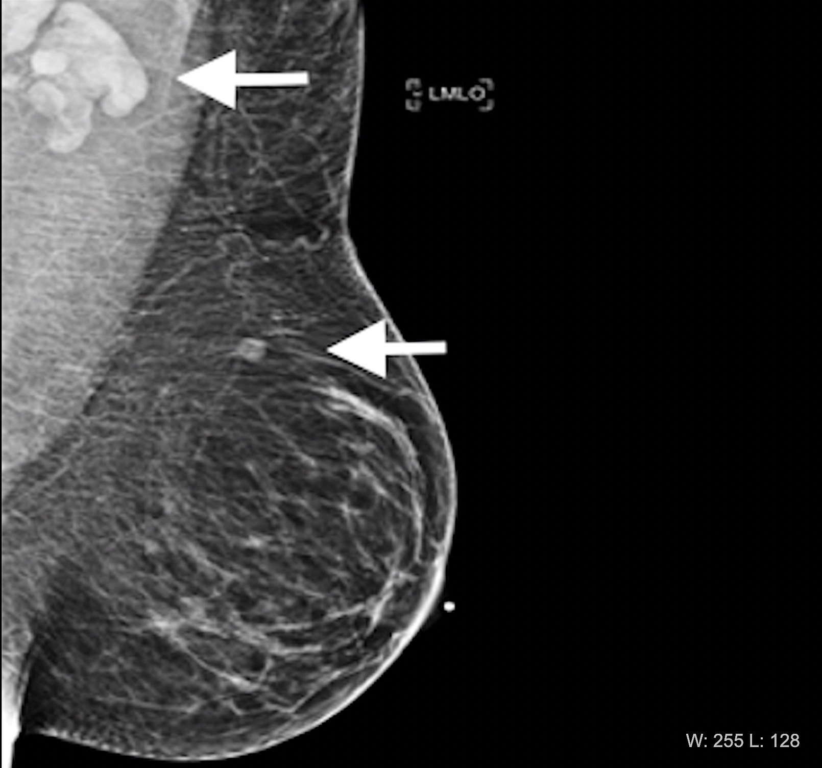 PHOTO GALLERY: What does breast cancer look like on mammography