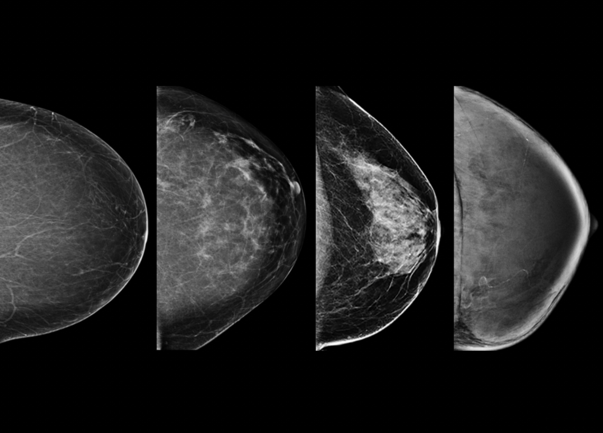 This mammograph provides a 2-dimensional rendering of the mean breast