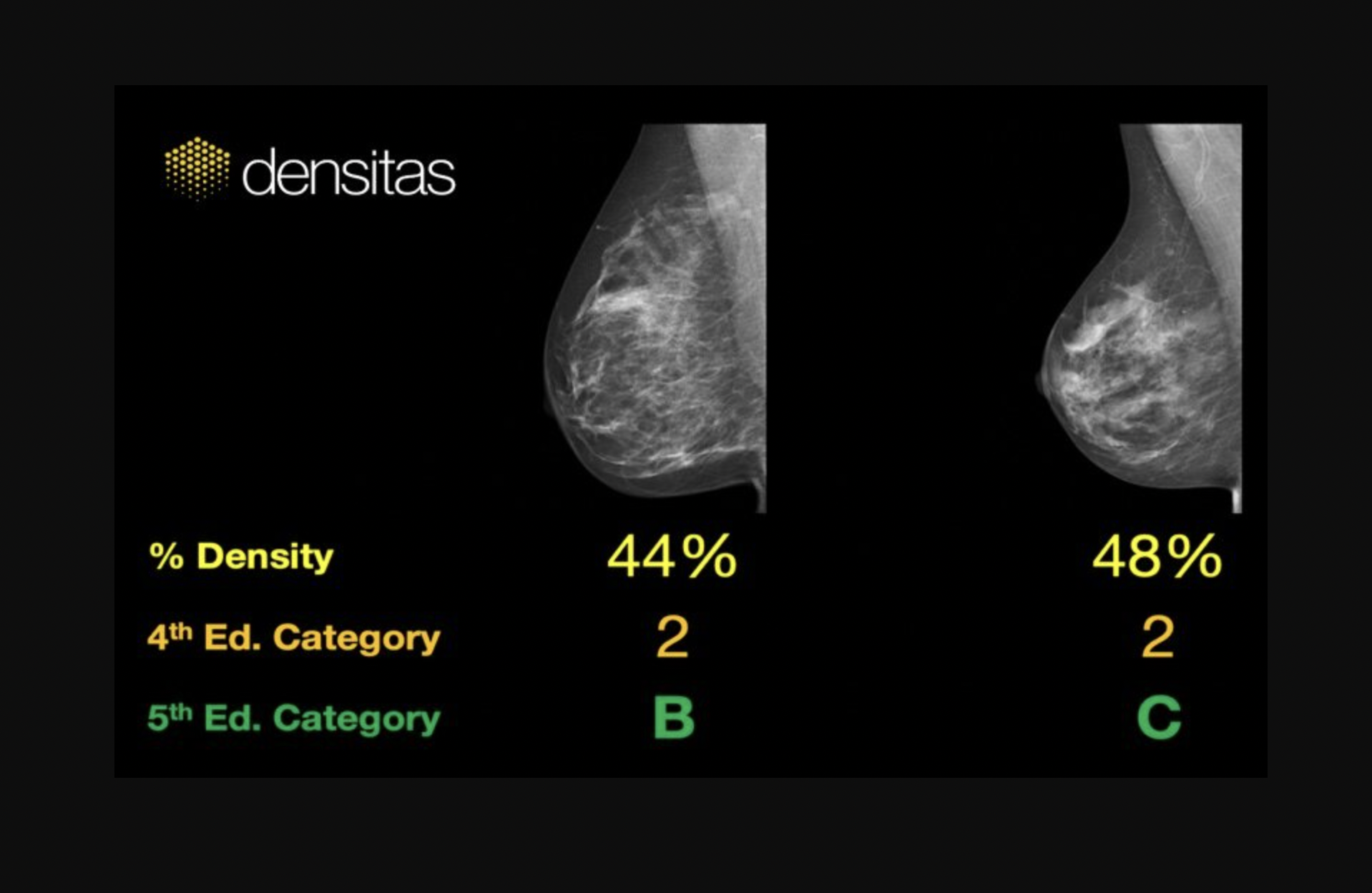 VIDEO: Role of AI in breast imaging with radiomics