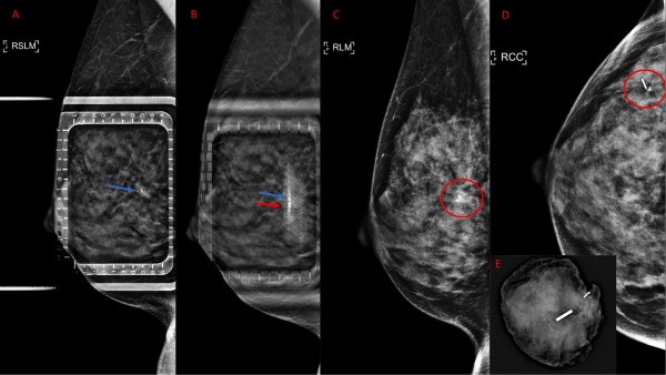 DBT guidance produces a significant drop in procedure time during