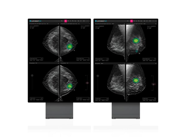Diagnostic Breast Imaging 第2版 Diagnostic Breast Imaging 第2版 Amazon.com: Diagnostic