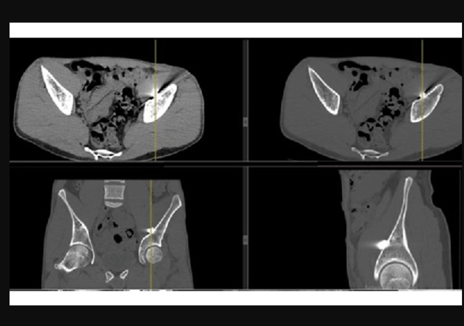 PHOTO GALLERY: Radiology images of Ukrainian trauma patients wounded in war