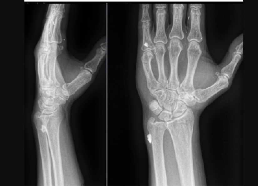 PHOTO GALLERY: Radiology images of Ukrainian trauma patients wounded in war