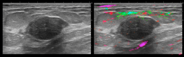 Benign Fibroadenoma - An example of a benign mass imaged with Imagio®—a typical fibroadenoma, with the OA image (right) showing a reassuring draping vessel and the very little activity in the central nidus.  Imaged using Seno OA/US.