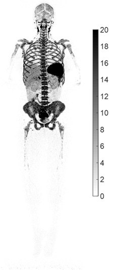whole-body PET