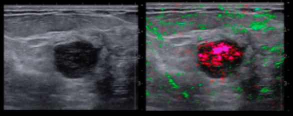 Triple Negative Cancer - An example of a triple-negative breast cancer discovered with Imagio® Imaging. The grayscale image (left) was initially reported as BI-RADS 3. The OA image (right) showed intense de-oxygenation in the central nidus, providing confidence that this mass should be biopsied.  Imaged using the Seno OA/US breast imaging technology.