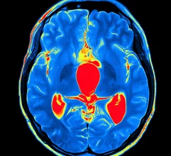 istock-614brainmri.jpg Thumbnail