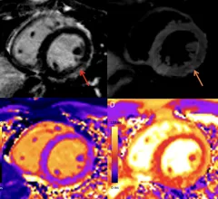 COVID-19 vaccine associated myocarditis on short-axis 1.5T MRI images of a 19-year-old man who presented with chest pain three days following the second dose of an mRNA COVID-19 vaccine.