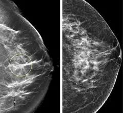 Comparison of a 2D digital mammogram and breast tomosynthesis 3D mammography from UCSF.