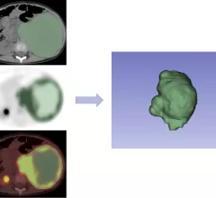 neuroblastoma prognosis