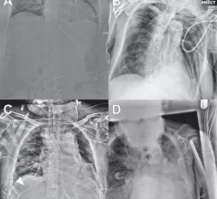 enteric tube placement on radiographs