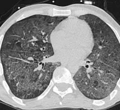 Lung CT of a 42-year-old man with more than 7 days of symptoms. Scans show COVID pneumonia with diffuse ground-glass opacities in close vicinity of visceral pleural surfaces. In addition, a crazy paving pattern is observed. Image courtesy of RSNA. Medical images of COVID. #COVID #SARS-CoV-2