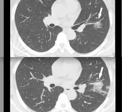 CT of coronavirus pneumonia, a solitary rounded ground-glass opacity (GGO) pattern. A 51-year-old woman in China presented in January 2020 without fever, but had close contact with positive patients. Top, baseline axial unenhanced chest CT obtained 6 days before the first positive PCR test. Bottom, chest CT scan 4 days later shows the size increase of the lesion (arrow). Image courtesy of RSNA. #COVID #SARSCoV2