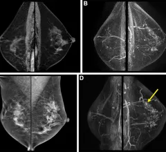 Surveillance breast MRI