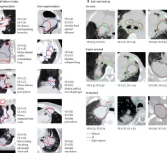 non-small cell lung cancer tumor segmentation