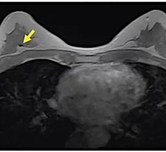 Breast MRI example showing a signal void in right breast (arrow) caused by biopsy on an axial contrast-enhanced in-phase Dixon image. It shows a signal void in right breast (arrow), which corresponded with a MammoMark/CorMark Bread Tie biopsy clip. Image courtesy of AJR.