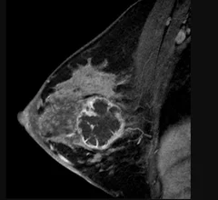 Sagittal images from breast MRI in a 36-year-old woman with an invasive ductal carcinoma. Image from pre-chemotherapy contrast-enhanced T1-weighted MRI shows a round, rim-enhancing mass. This subtraction image shows the maximal diameter of the mass was measured up to 5.4 cm. Read more. RSNA image. What does breast cancer look like?