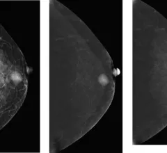 contrast enhanced mammography