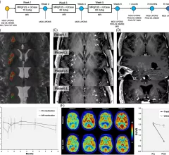 focused ultrasound Parkinson's