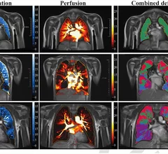 long covid lung damage in children