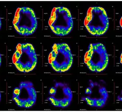 cerebral palsy PET imaging