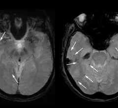 brain scans of woman who died after taking experimental alzheimer's drug