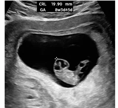 As the pregnancy advances, the embryo is easier to see, and accurate measurements can be obtained with transabdominal ultrasound. A crown-rump length (CRL) measurement. This ultrasound scan shows the CRL, which is the average of discrete fetal measurements from the tip of the head end to the tip of the rump end in the midsagittal plane of the embryo. This is highly accurate for pregnancy dating. Images courtesy of RSNA