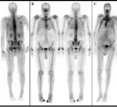 cardiac amyloidosis on bone scan