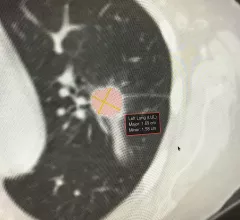 Example of artificial intelligence generated measurements to quantify the size of a lung cancer nodule during a followup CT scan to see if the lesion is regressing with treatment. This type of automation can aid radiologists by doing the tedious, time consuming work. Photo by Dave Fornell