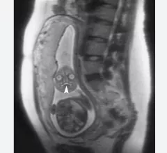 An MRI of a fetus inside the mother. The freakish appearance of the eyes and the face are normal for MRI fetal imaging. Image courtesy of RSNA