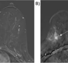 #DCIS #invasivebreastcancer #cancerupgrade #breastMRI