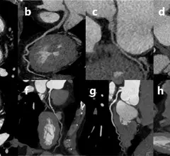 CCTA with patient-specific versus fixed post-trigger delay