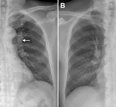 lung cancer imaging features associated with worse outcomes following missed diagnosis