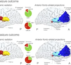 brain connections that cause epileptic seizures