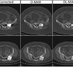 metal artifacts on CT
