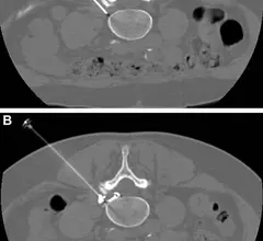 pulsed radiofrequency for sciatica
