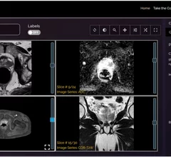 Learning app improves reader performance for prostate MRI