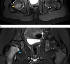 osteomyelitis on MRI
