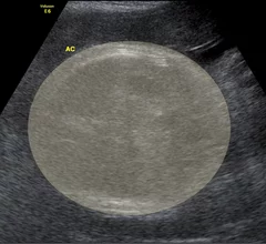 fetal weight measurements ultrasound