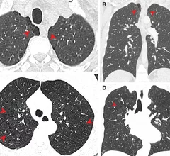 Lung damage from study