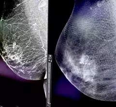 GE HealthCare Breast Cancer AI