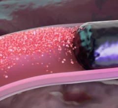 FDA announces recall of Boston Scientific's Obsidio Conformable Embolic 