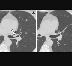 Lung cancer screening CT image in a 66-year-old male patient shows a sessile nodule with internal air in the left mainstem to left upper lobe bronchus (arrow) with a mean diameter of 10 mm. The nodule was assigned as Lung-RADS category 4A in the clinical report. (B) Follow-up CT image shows the lesion is resolved. Image courtesy of RSNA