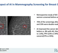 AI decision support tool used in breast cancer screening