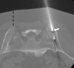 CT guided bone marrow biopsy