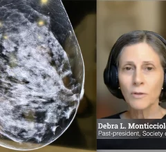 Debra L. Monticciolo, MD, FACR, FSBI, past-president of both the Society of Breast Imaging (SBI), and the American College of Radiology (ACR), explains the current recommendations and a study she did looking at real patient data and projected outcomes using different screening parameters.